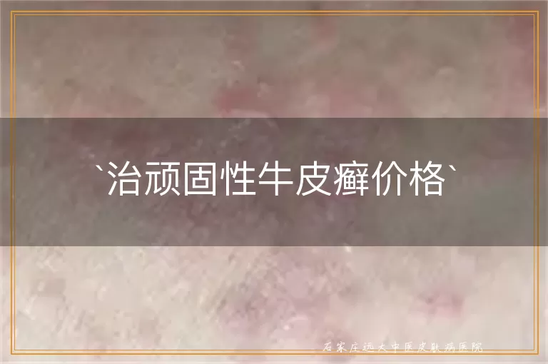 治顽固性牛皮癣价格