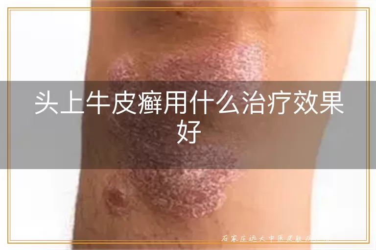 头上牛皮癣用什么治疗效果好