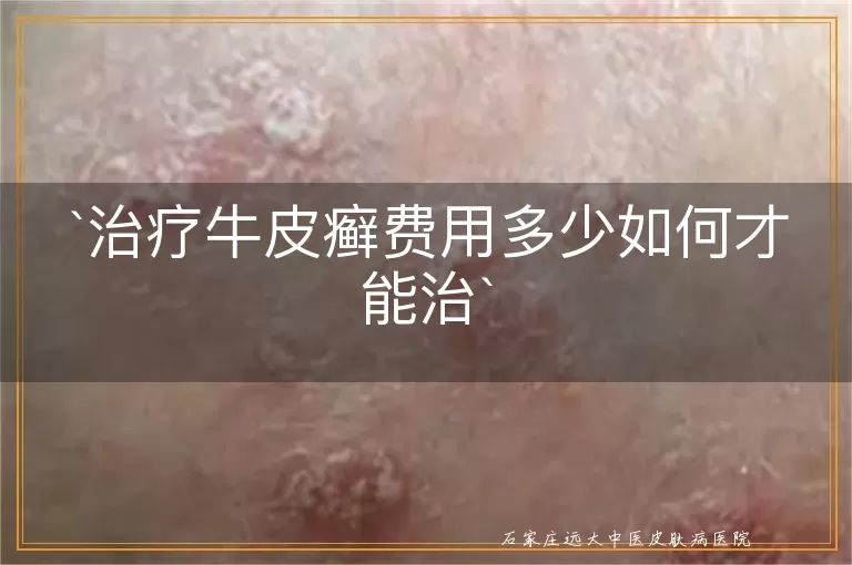 治疗牛皮癣费用多少如何才能治