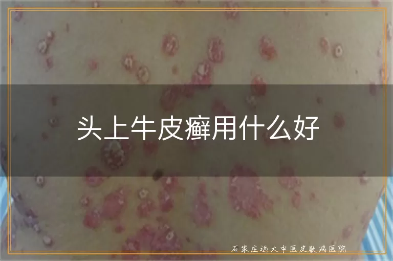 头上牛皮癣用什么好