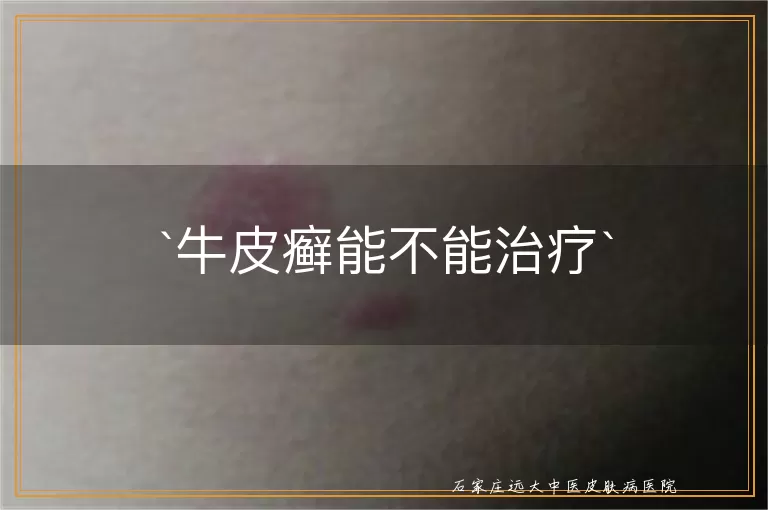 牛皮癣能不能治疗