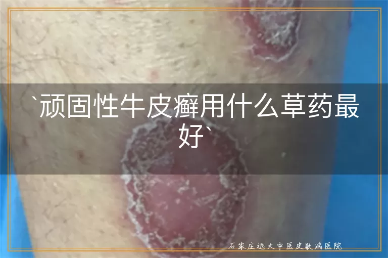 顽固性牛皮癣用什么草药最好
