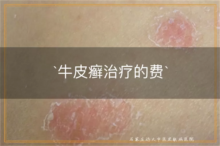 牛皮癣治疗的费