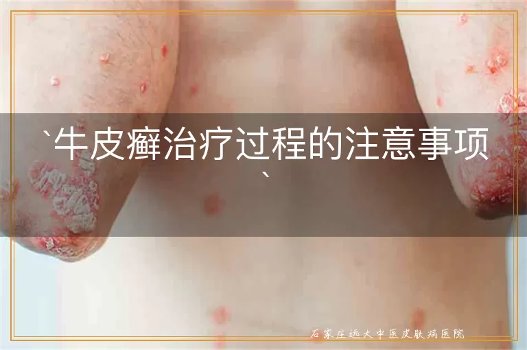 牛皮癣治疗过程的注意事项