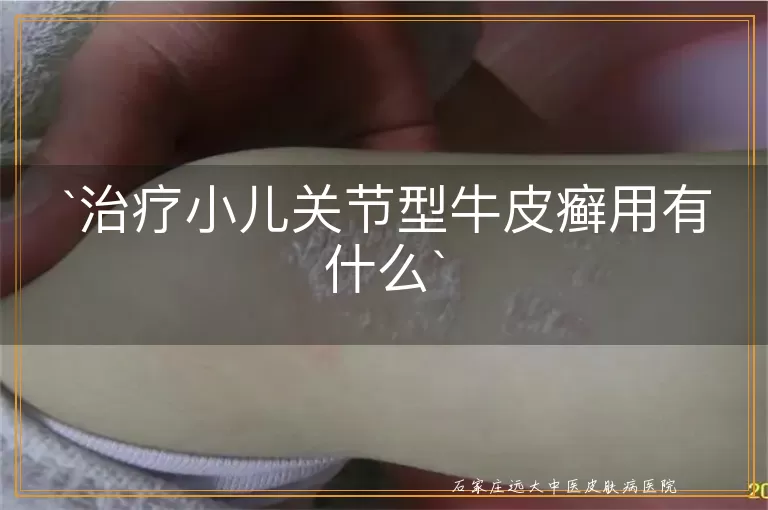 治疗小儿关节型牛皮癣用有什么