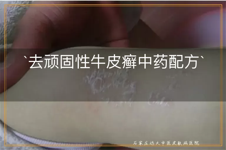 去顽固性牛皮癣中药配方