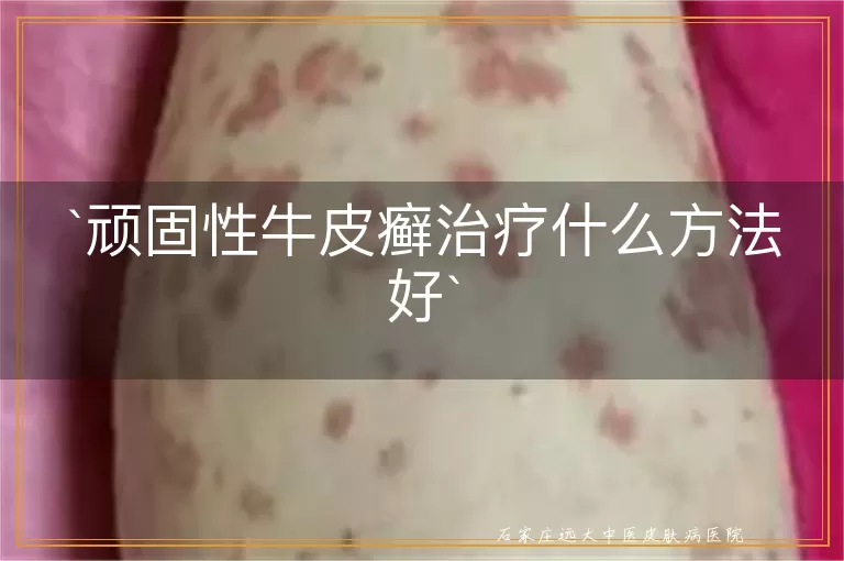 顽固性牛皮癣治疗什么方法好