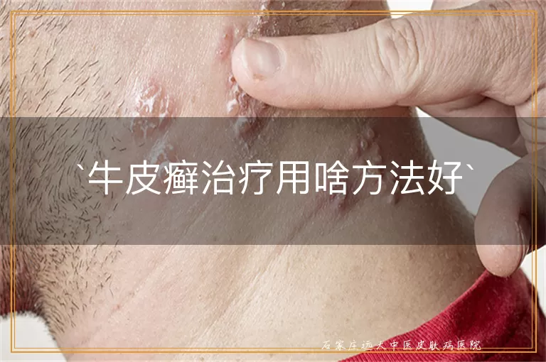 牛皮癣治疗用啥方法好
