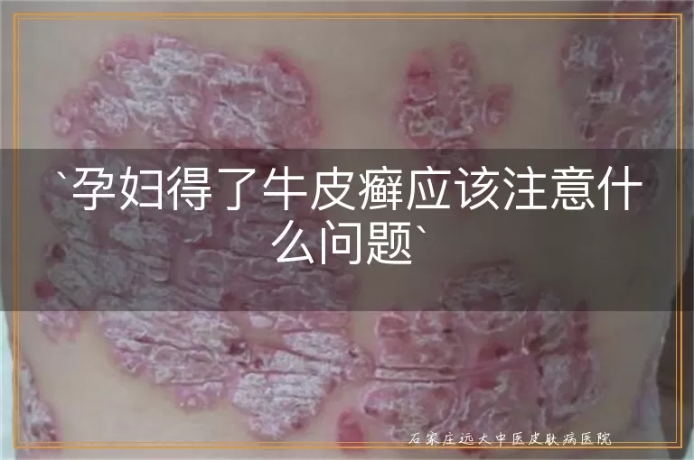 孕妇得了牛皮癣应该注意什么问题