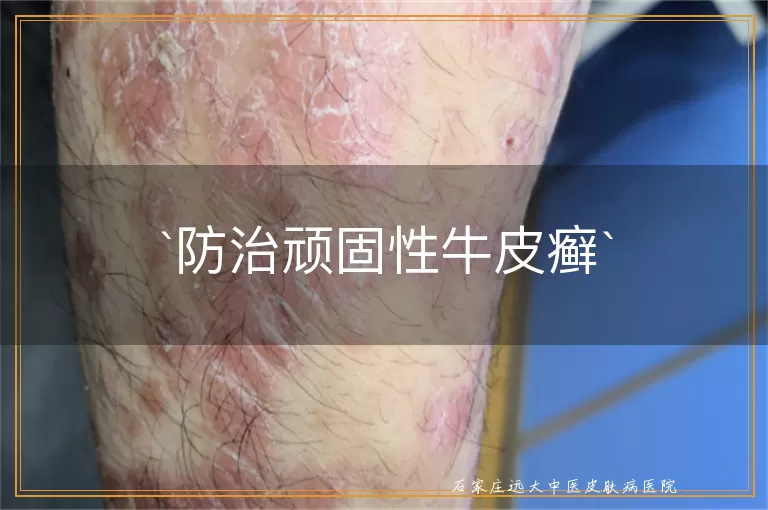 防治顽固性牛皮癣