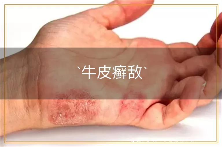 牛皮癣敌