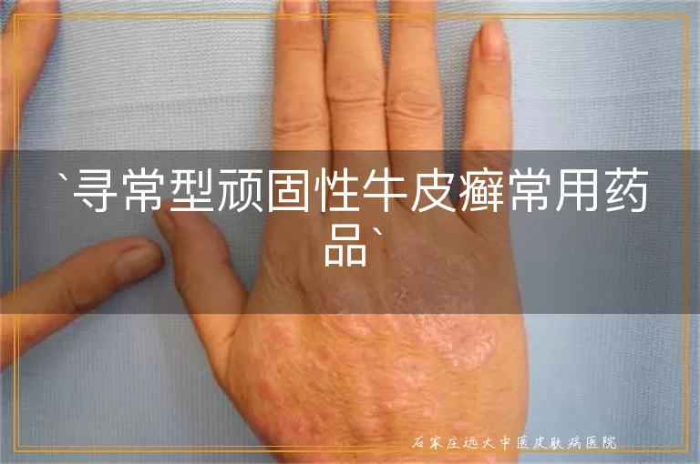 寻常型顽固性牛皮癣常用药品