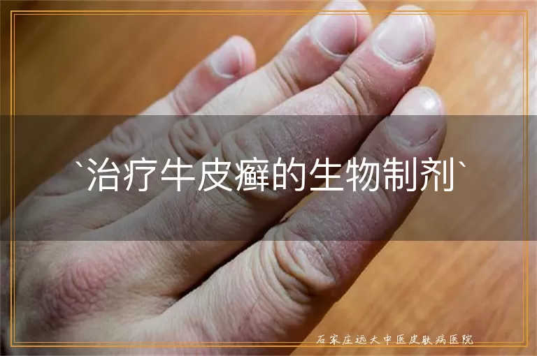 治疗牛皮癣的生物制剂