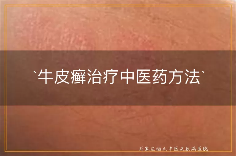 牛皮癣治疗中医药方法