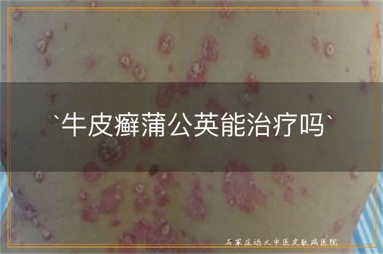 牛皮癣蒲公英能治疗吗