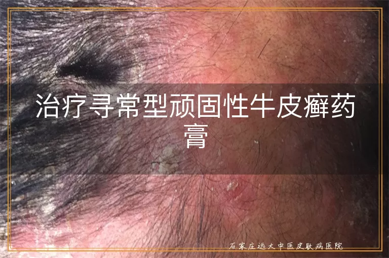 治疗寻常型顽固性牛皮癣药膏