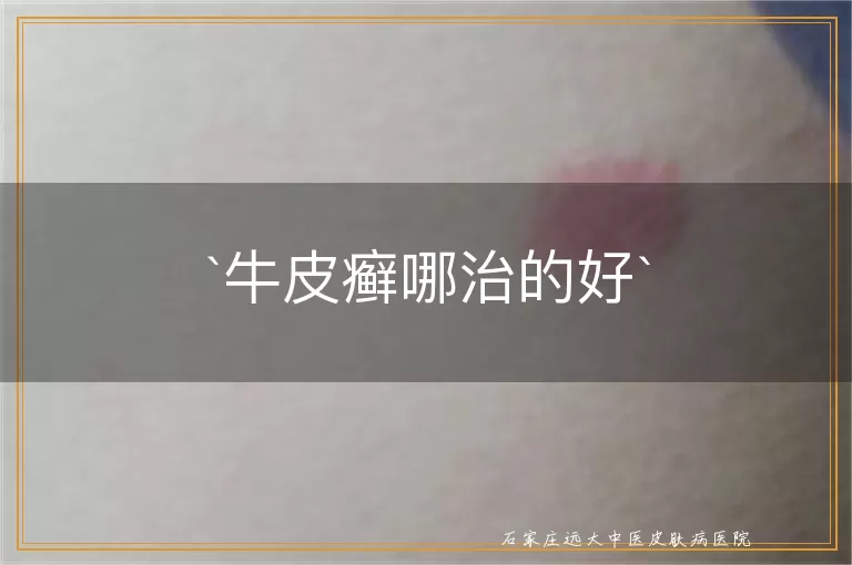 牛皮癣哪治的好