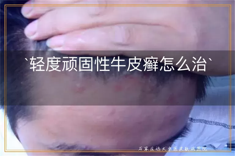 轻度顽固性牛皮癣怎么治