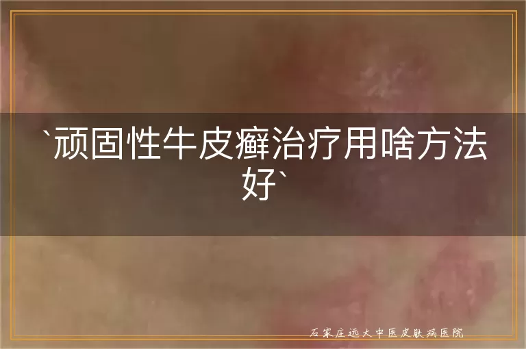 顽固性牛皮癣治疗用啥方法好