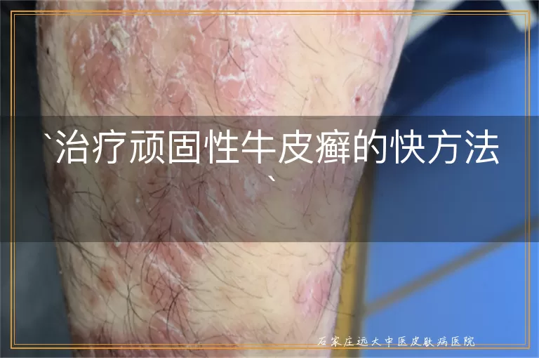 治疗顽固性牛皮癣的快方法