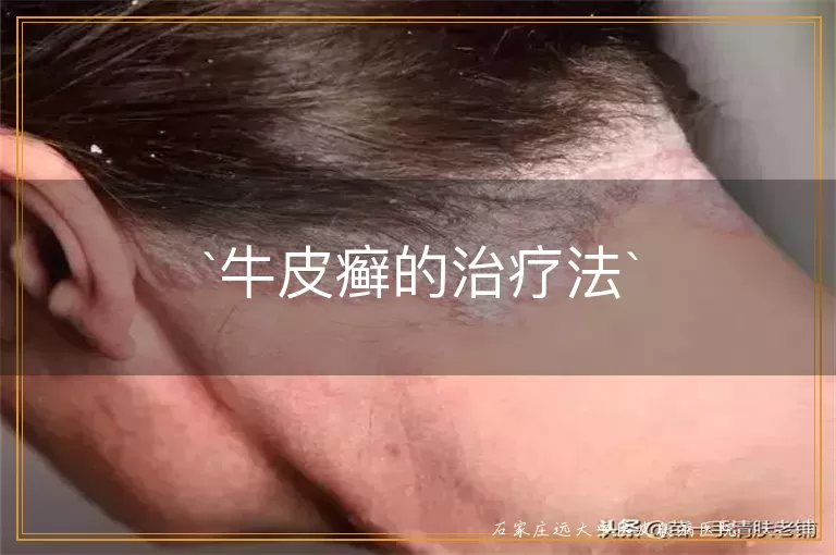 牛皮癣的治疗法
