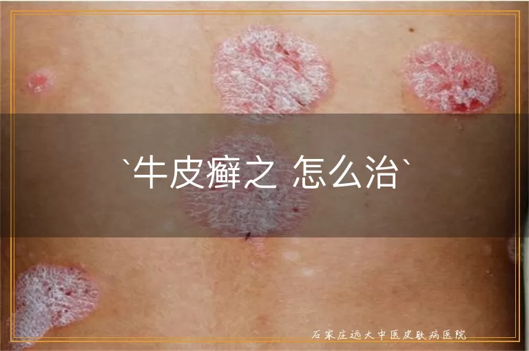 牛皮癣之 怎么治