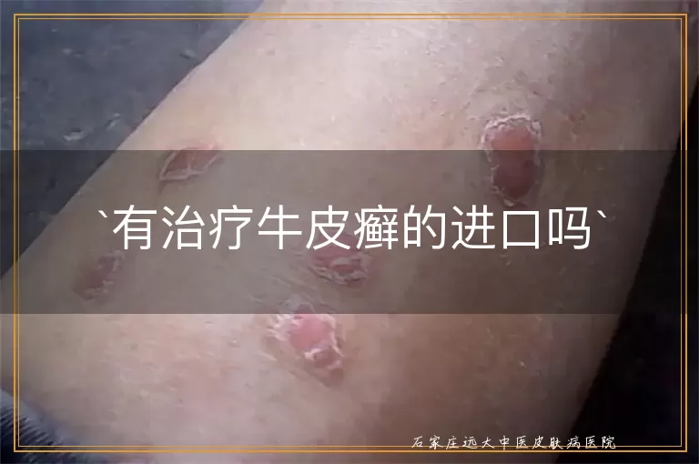 有治疗牛皮癣的进口吗