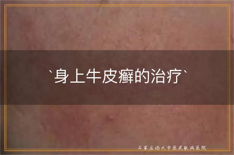 身上牛皮癣的治疗