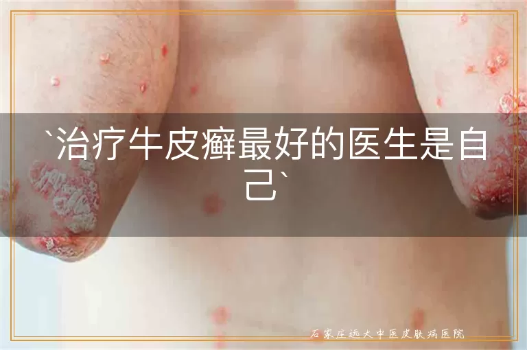 治疗牛皮癣最好的医生是自己