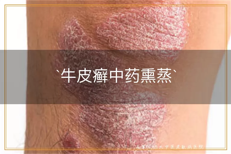 牛皮癣中药熏蒸