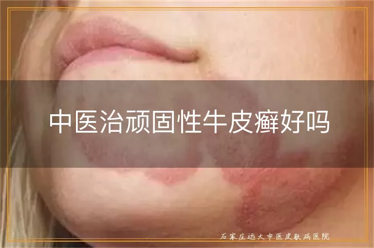 中医治顽固性牛皮癣好吗