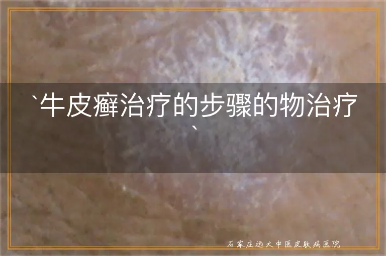 牛皮癣治疗的步骤的物治疗