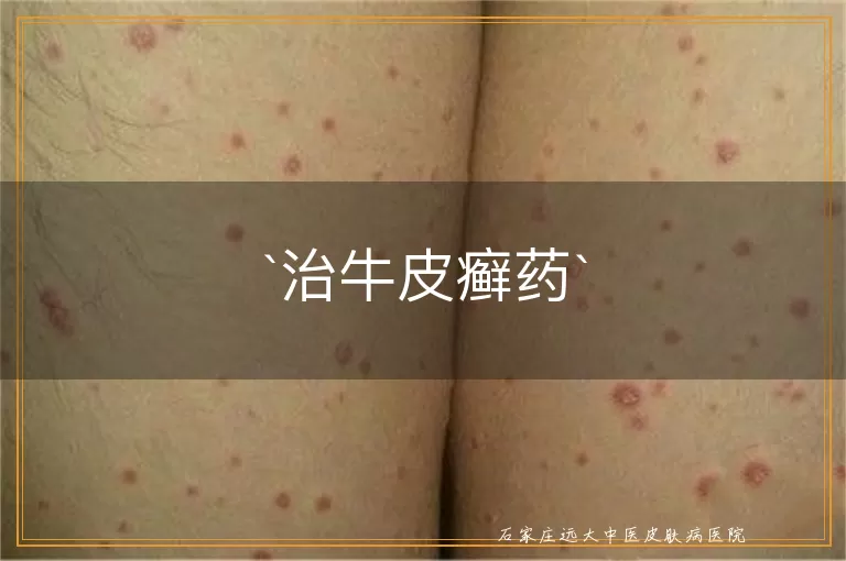 治牛皮癣药