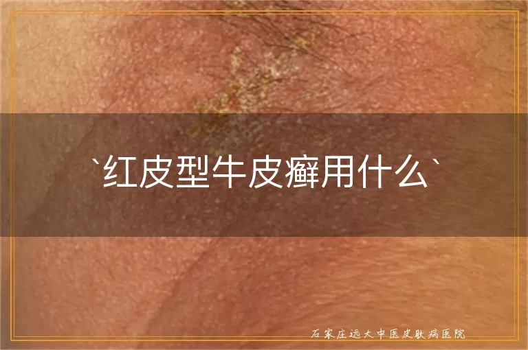 红皮型牛皮癣用什么