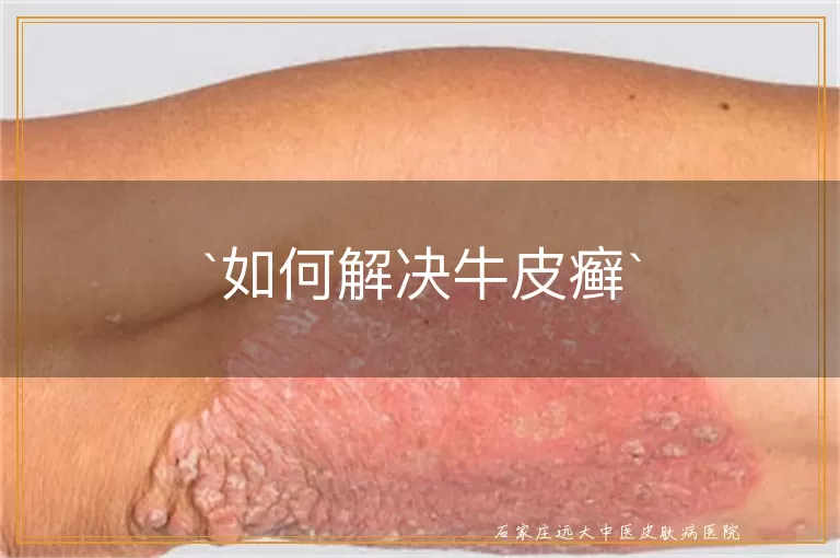 如何解决牛皮癣