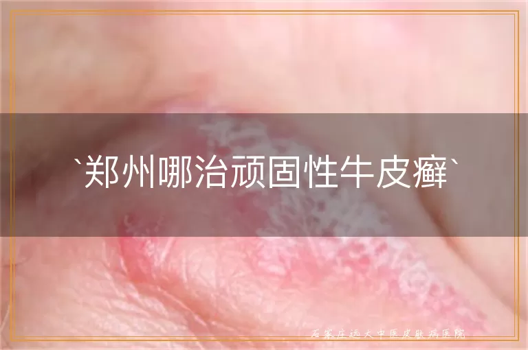郑州哪治顽固性牛皮癣