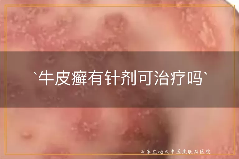 牛皮癣有针剂可治疗吗
