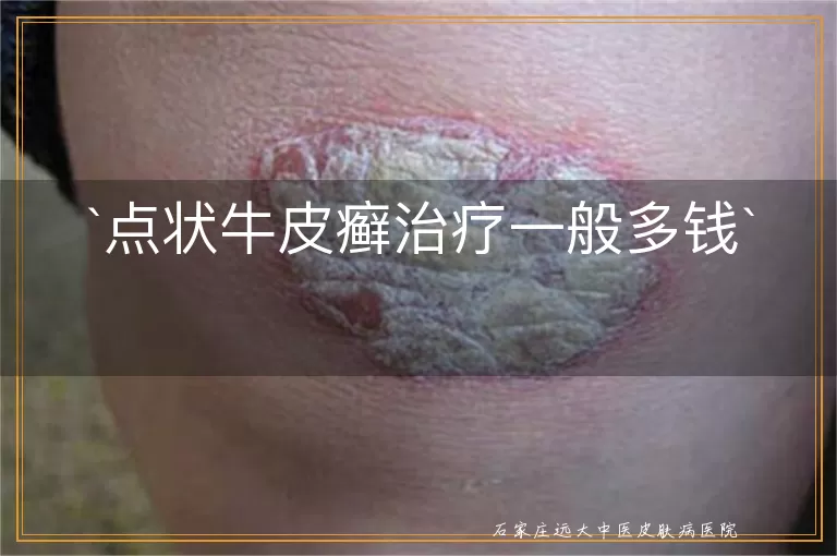 点状牛皮癣治疗一般多钱