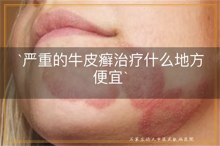 严重的牛皮癣治疗什么地方便宜