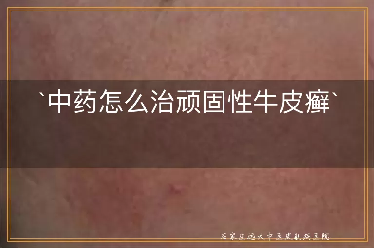 中药怎么治顽固性牛皮癣