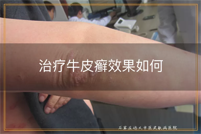 治疗牛皮癣效果如何