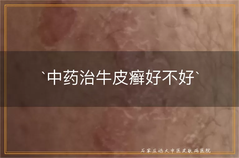 中药治牛皮癣好不好