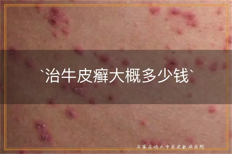 治牛皮癣大概多少钱