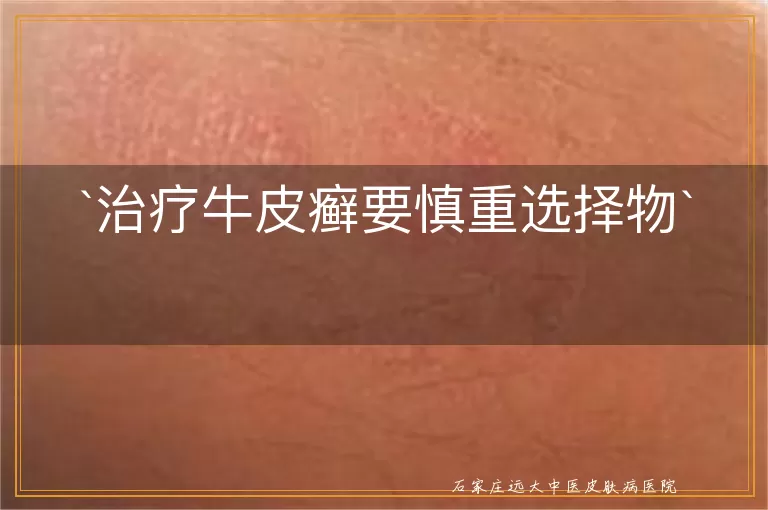 治疗牛皮癣要慎重选择物