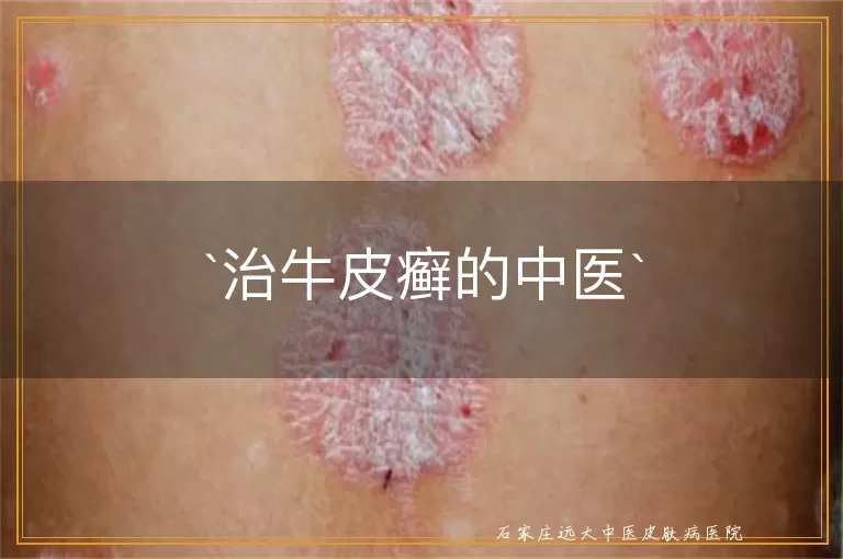 治牛皮癣的中医