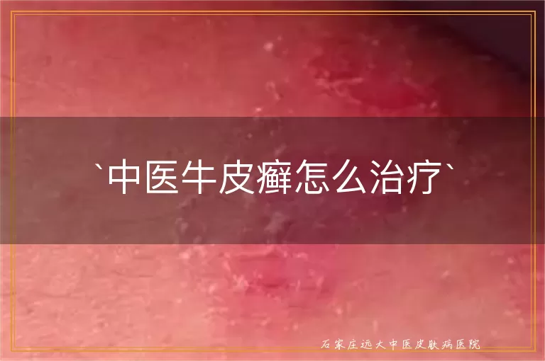 中医牛皮癣怎么治疗