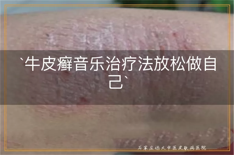 牛皮癣音乐治疗法放松做自己