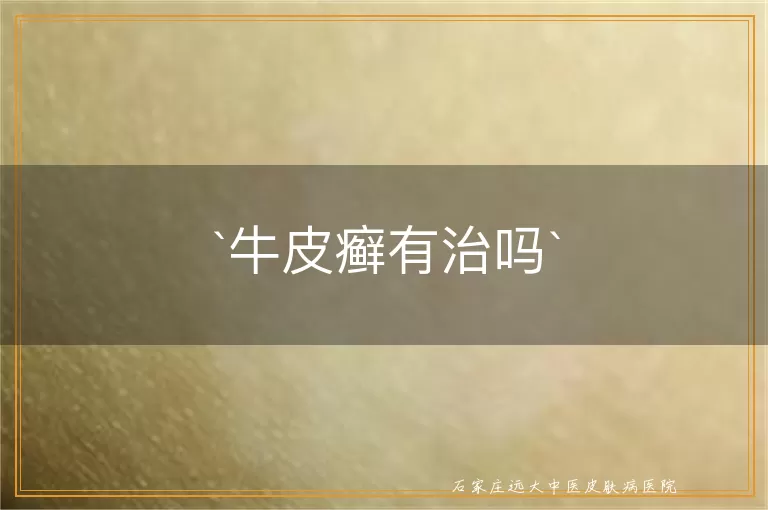 牛皮癣有治吗