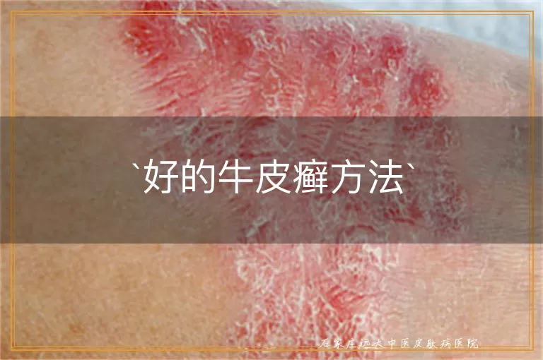 好的牛皮癣方法