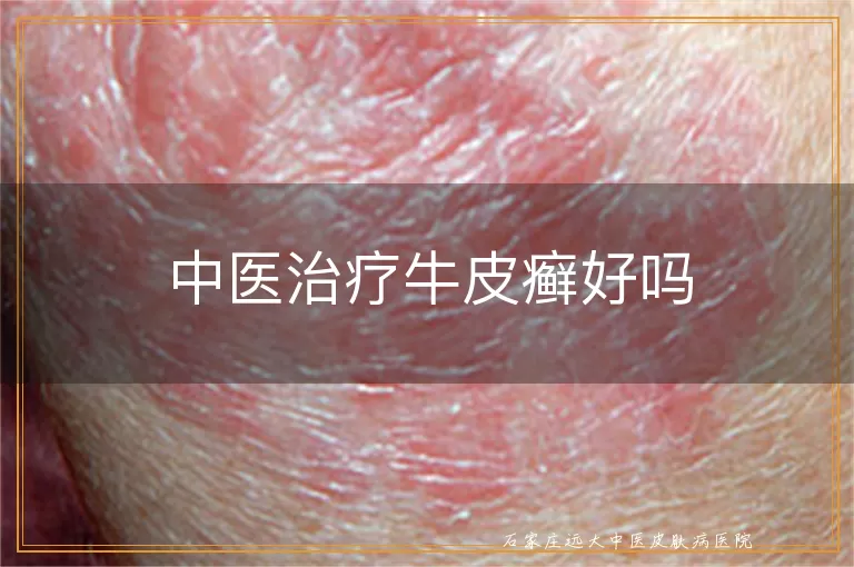 中医治疗牛皮癣好吗